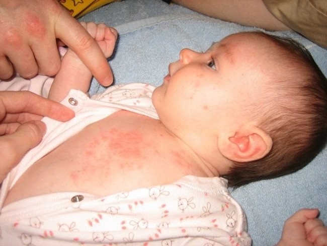 10 bệnh thường gặp ở trẻ vào mùa thu, triệu chứng và cách phòng ngừa 